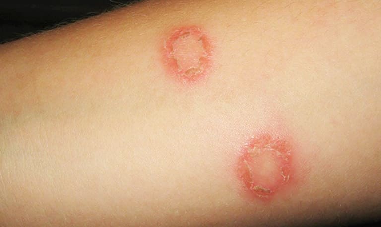 Nấm da hay hắc lào là bệnh thường gặp ở các nước nhiệt đới nóng ẩm